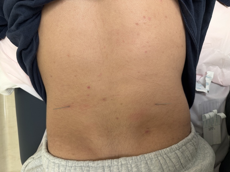 Acupuncture needles placed in a person's lower back